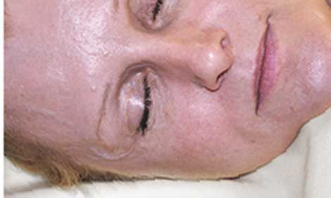 A specially designed pillow may help eliminate facial lines.