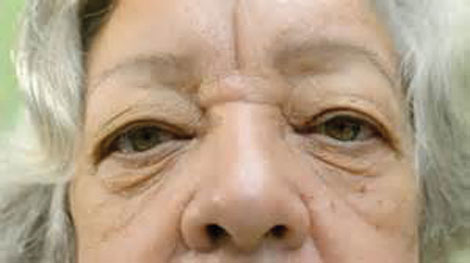 The leading cause of poor vision and legal blindness after the age of 60 is age-related macular degeneration.